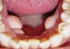 Lump in the sky in the mouth: possible causes