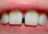 התפרצות של שיניים טוחנות בילד: סדר ותסמינים, צילום