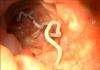 Защо червеите са опасни при възрастни, симптоми и лечение Какво причинява червеи при възрастни?